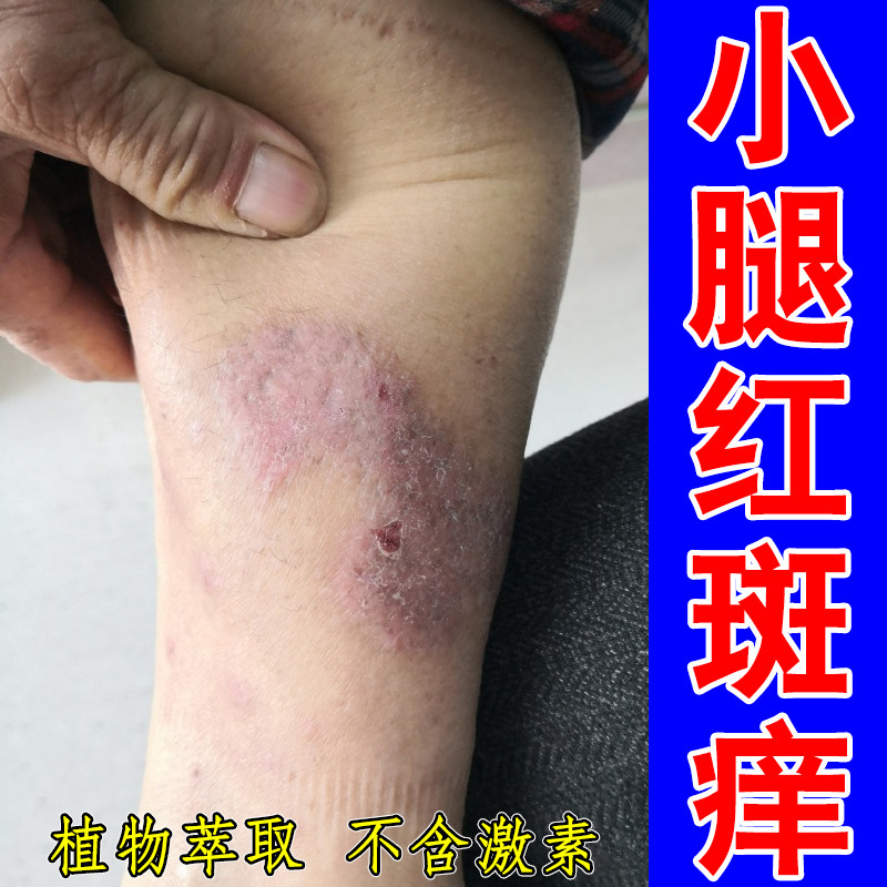 小腿红斑痒身上长红疙瘩红点过敏性神经性老年人小腿痒刺挠红肿痒