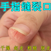 手指缝裂口专用指甲裂口子脱皮真菌蜕皮去角质蜕皮修复保湿 药乳膏
