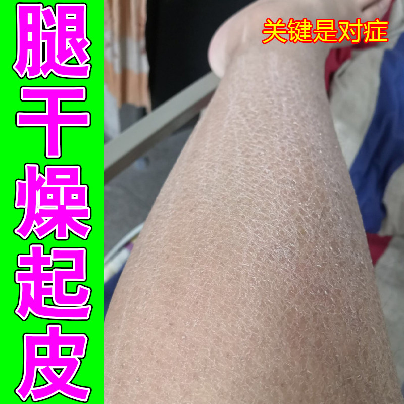 腿部肌肤干燥起皮脱白屑小腿干痒粗糙起干纹下肢缺水起皮全身润肤
