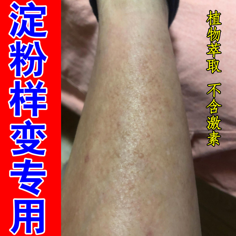 腿上粗糙疙瘩多发坚实小颗粒褐色沉淀斑皮肤抓挠后增厚粗糙干燥痒