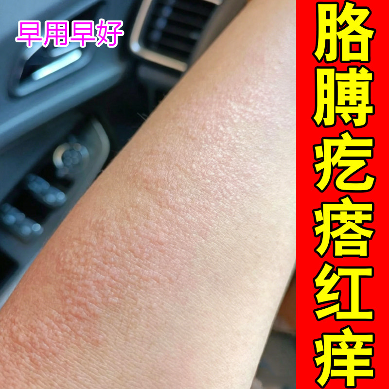 胳膊疙瘩红痒皮肤过敏痒紫外线日光性过敏晒伤红肿脱皮掉屑草本药