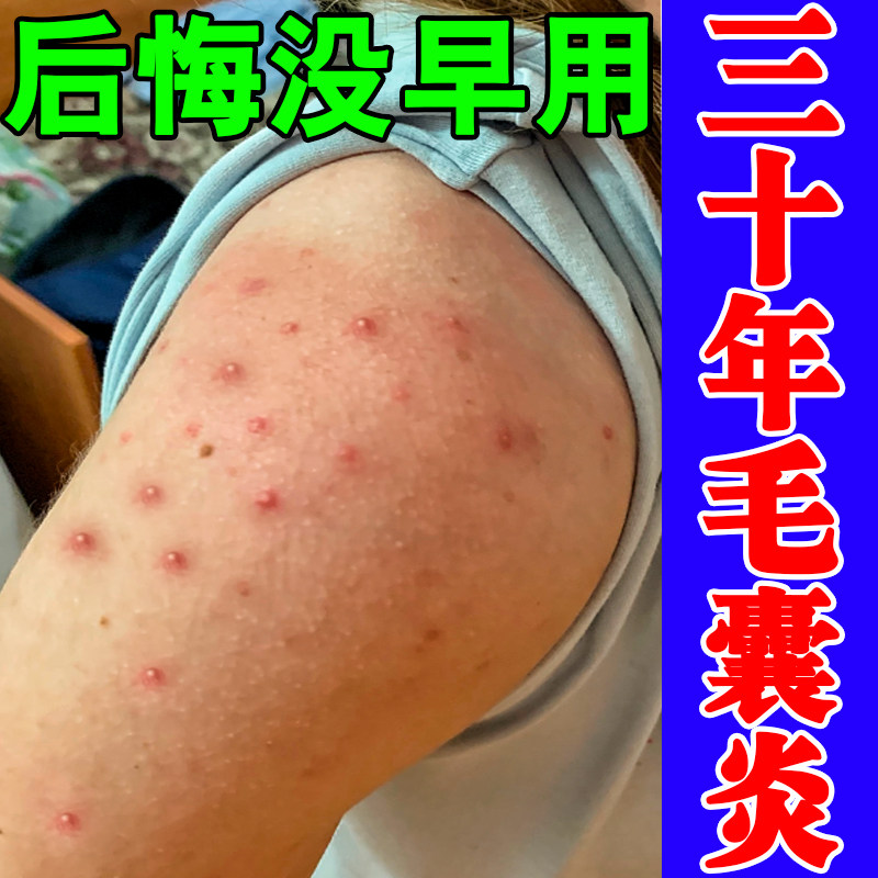 手臂毛囊胳膊长疙瘩外用痒剂
