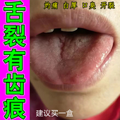 舌头裂痕地图舌齿痕舌调理灼口综合症裂纹有齿痕舌苔白厚冶烂嘴药