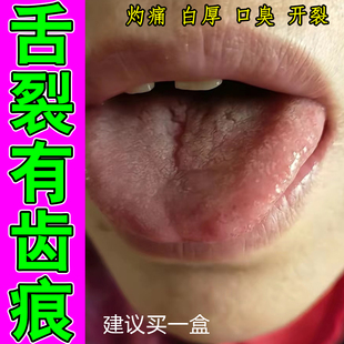 舌头裂痕地图舌齿痕舌调理灼口综合症裂纹有齿痕舌苔白厚冶烂嘴药
