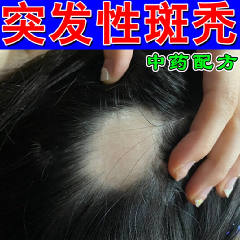 突发性斑秃儿童头发稀少掉发地中海脂溢性发量少遗传性压力大脱发
