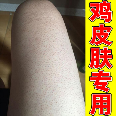 腿上皮肤疙瘩毛囊毛周角化除症手臂脸上腿部药胳膊红点黑点膏