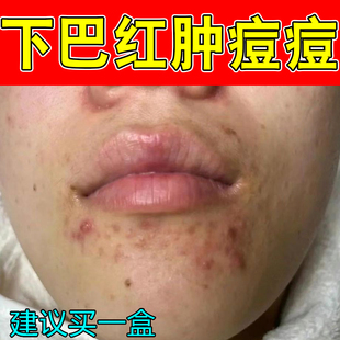 下巴红肿痘痘脸上长疙瘩起硬块脓包青春痘干燥粗糙嘴周上火保湿药