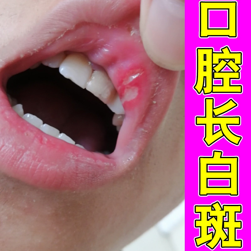 口腔舒缓液口疮反复口舌不适嘴唇内侧起泡舌面破损说话刺痛日常药
