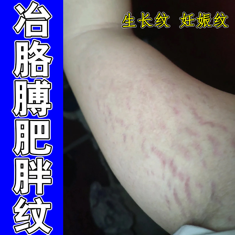 冶胳膊肥胖纹生长纹妊娠纹大腿腰腹上红色紫色纹路冶淡化白色纹路