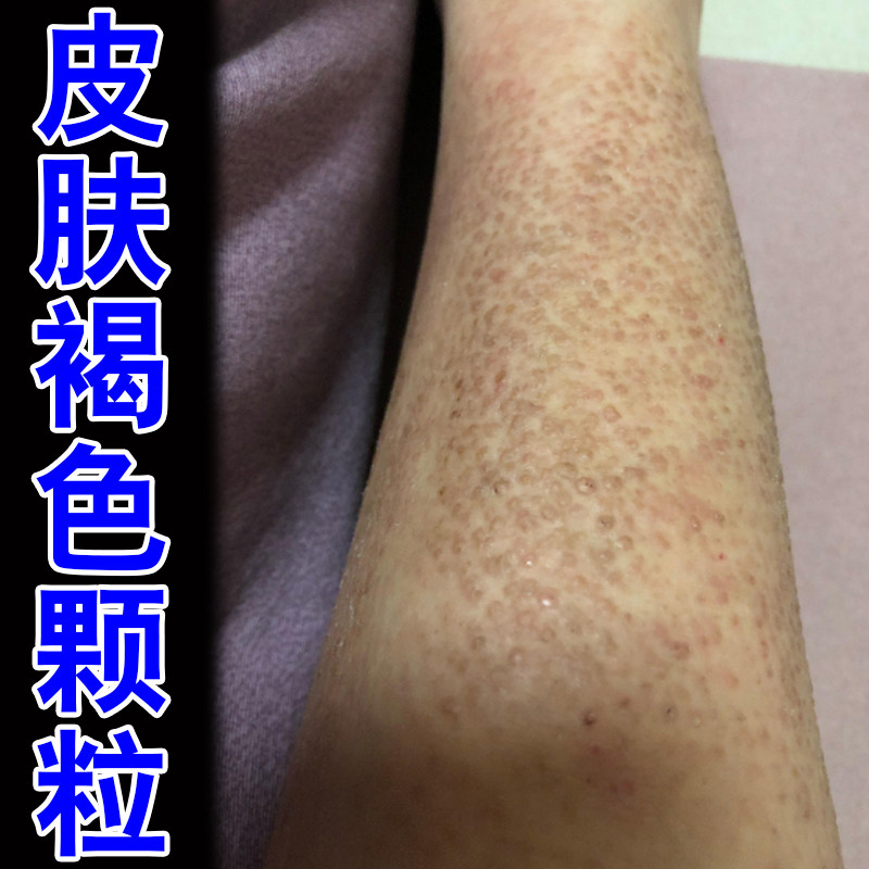 皮肤粗糙颗粒顽固小腿后背黑色素沉淀增厚褐色蛋白沉积修护保湿药