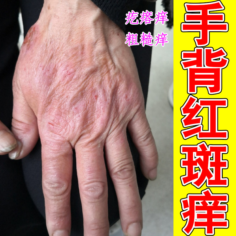 手背红斑痒疙瘩痒粗糙痒脱皮裂口真菌感染手指关节痒鹅掌风起硬块