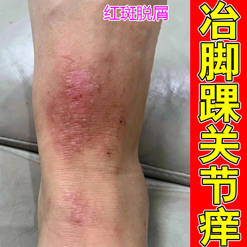 脚踝关节红皮肤干燥粗糙掉屑红肿长红斑脱屑脚干燥外用修复药乳膏
