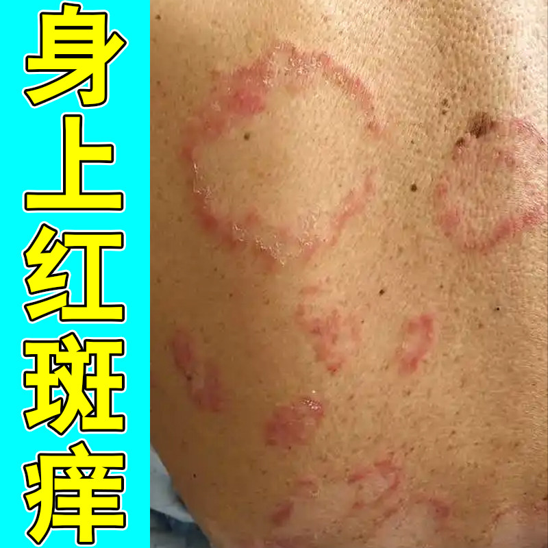 身上红斑痒身体环状斑块泛红脱屑刺痒干皮粗糙红肿过敏草本修护药