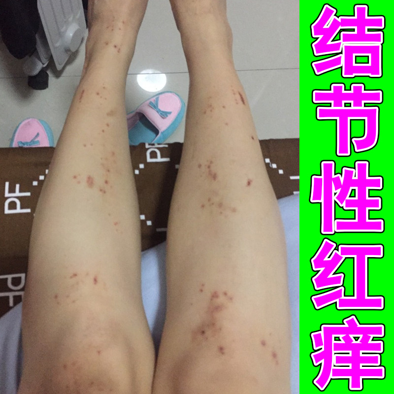 结节性红痒掉屑身上皮肤干燥痒起硬块疙瘩黑褐色沉淀红肿起皮掉屑