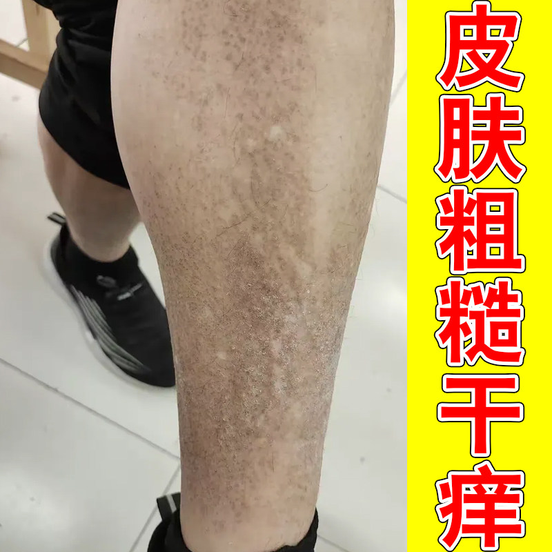 皮肤粗糙干燥褐色蛋白沉积起疙瘩小颗粒黑色素沉淀顽固后背疙瘩痘