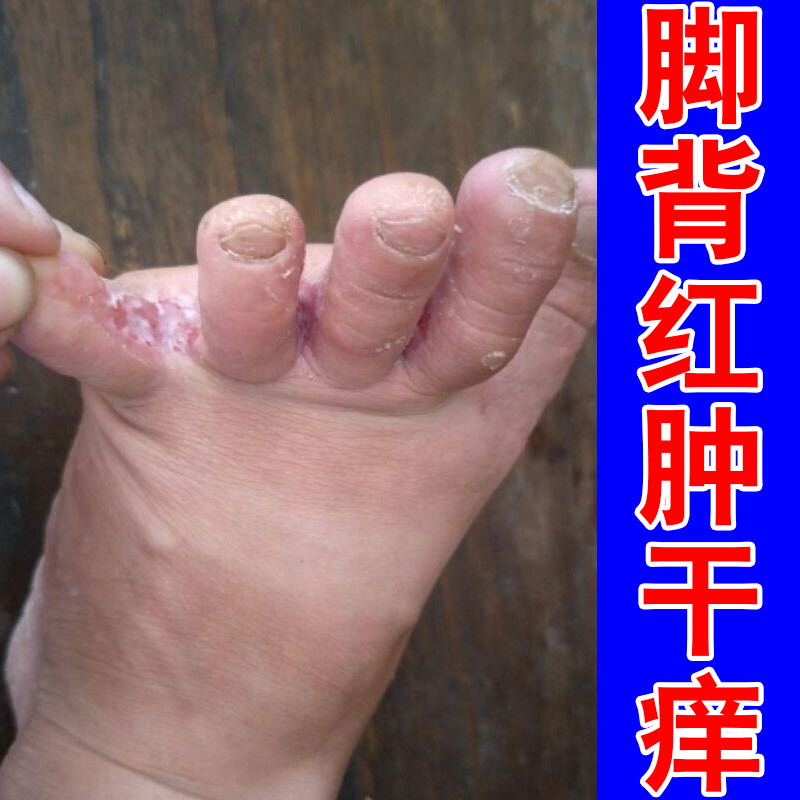 脚背红肿干痒脚趾缝泛白红脚底长水泡脚底粗糙干燥感染起疙瘩臭脚