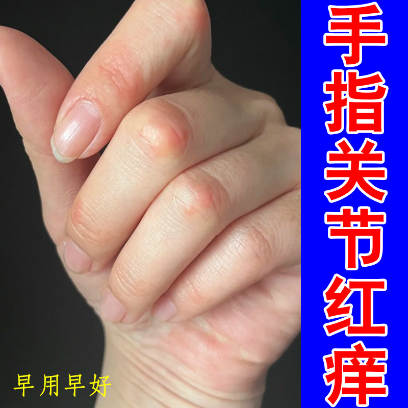 手指关节红痒干燥裂口子掉屑指节角垫凸起长硬疙瘩肉垫硬皮专用膏