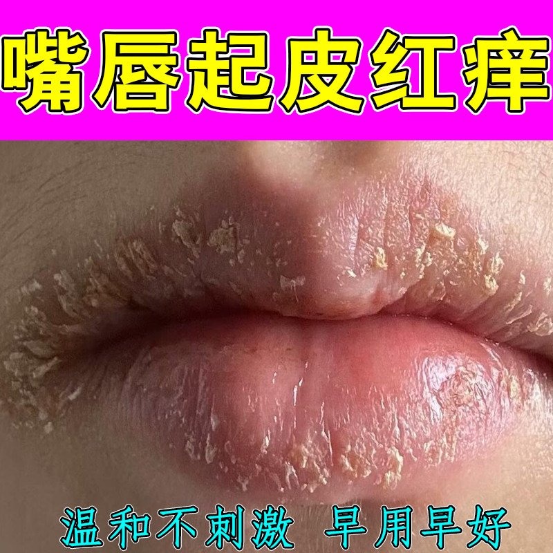 嘴唇起皮红痒掉屑嘴唇边干裂口干燥脱皮红肿粗糙儿童羊山胡草本膏