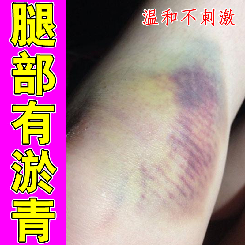 冶走路磕碰腿部出现青紫色印记小腿外侧碰撞乌青斑块大腿皮下暗色