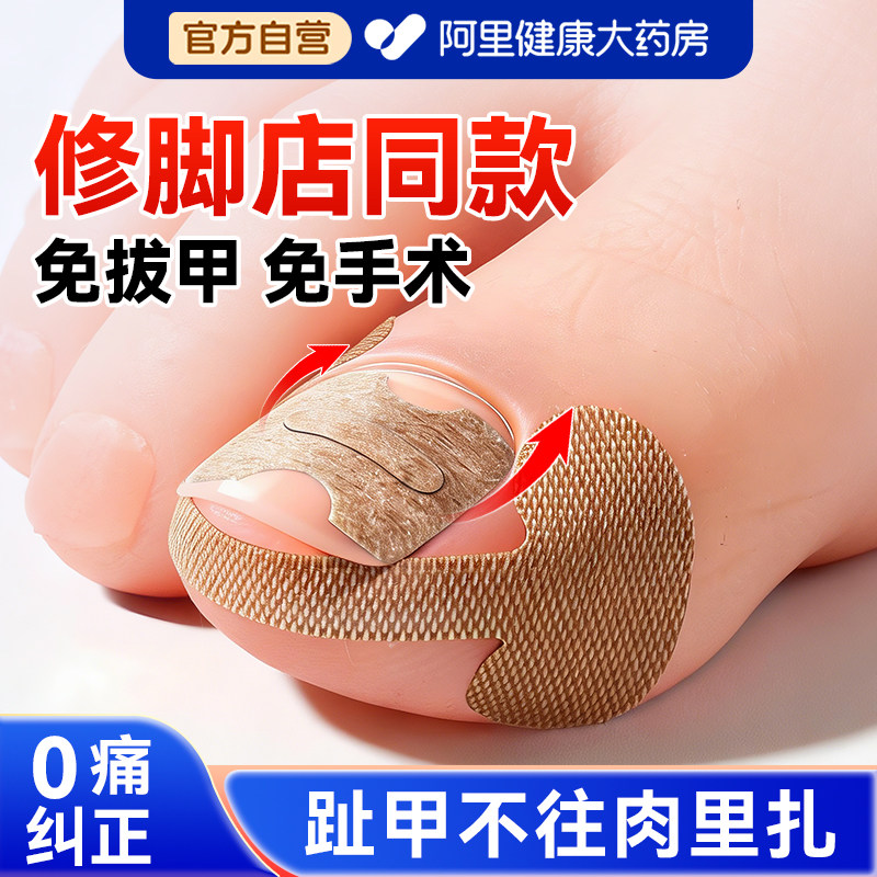 甲沟矫正器贴片炎嵌甲神器防脚指甲往肉里长专用隔离工具填充垫片