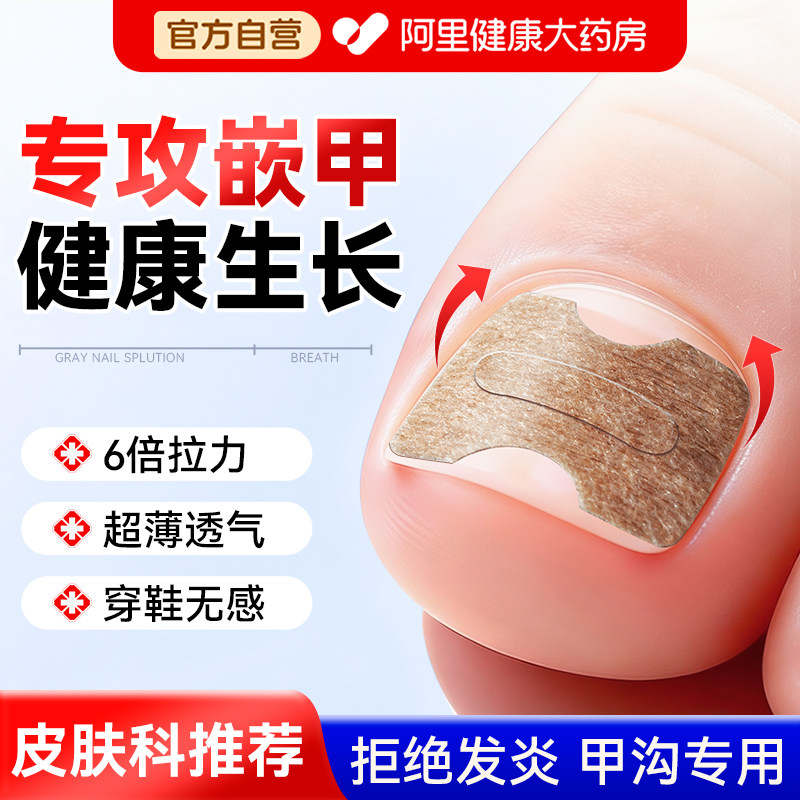 正甲贴甲沟垫片嵌甲专用指甲矫正器卷甲脚沟炎脚趾甲往肉里长神器,家庭/个人清洁工具,美甲/修甲套装,淘宝优惠券,粉丝福利购,淘宝优惠卷