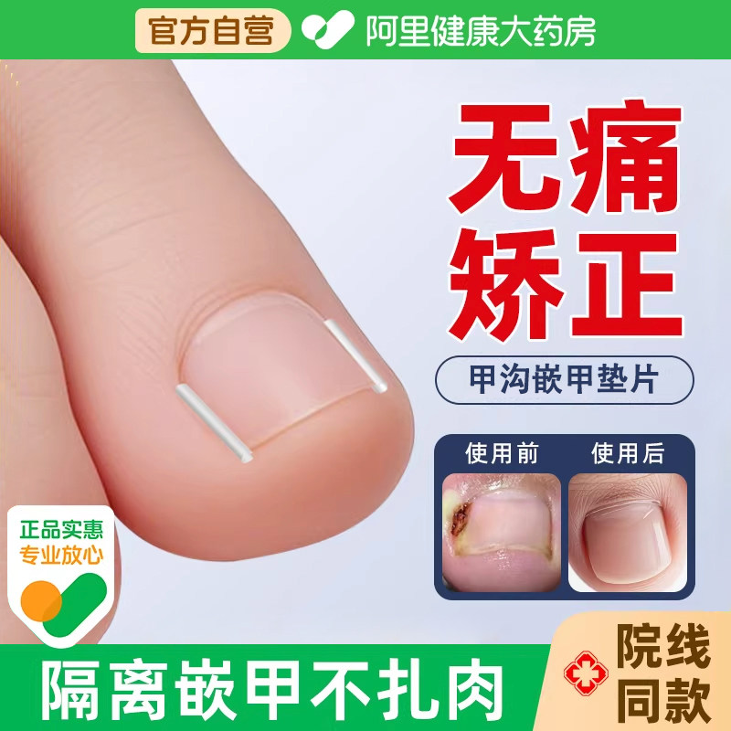 甲沟矫正器填充垫片炎嵌甲神防脚指甲往肉里长专用治工具疗贴片器
