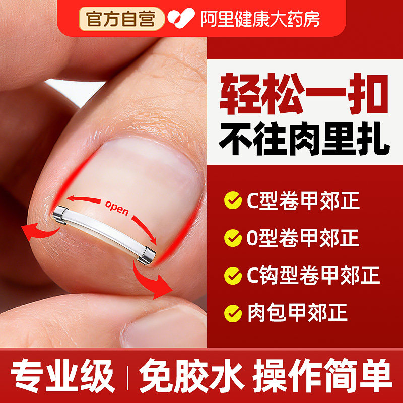 甲沟矫正器嵌甲矫正器正甲扣脚趾甲卷甲正甲贴片指甲长肉里神器炎
