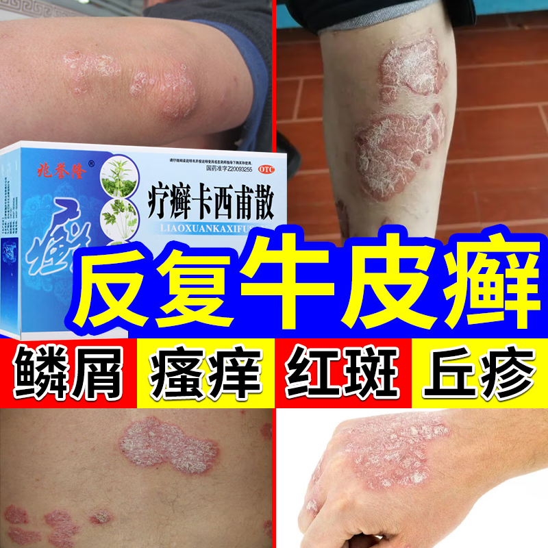 顽固性牛皮藓银屑病专用药 皮癣体癣专用去癣药膏 止痒 无激素