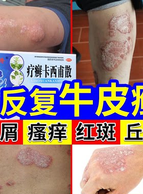 【金芙克】疗癣卡西甫散10g*4袋/盒