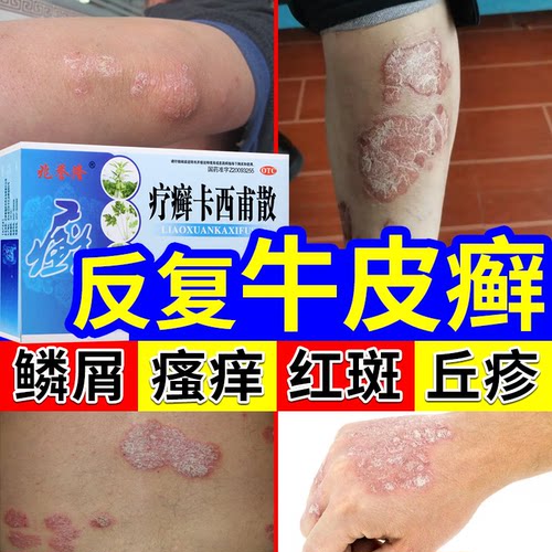 【金芙克】疗癣卡西甫散10g*4袋/盒