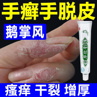 治疗鹅掌风的药手癣手脱皮足癣手掌粗糙开裂真菌感染瘙痒杀菌止痒