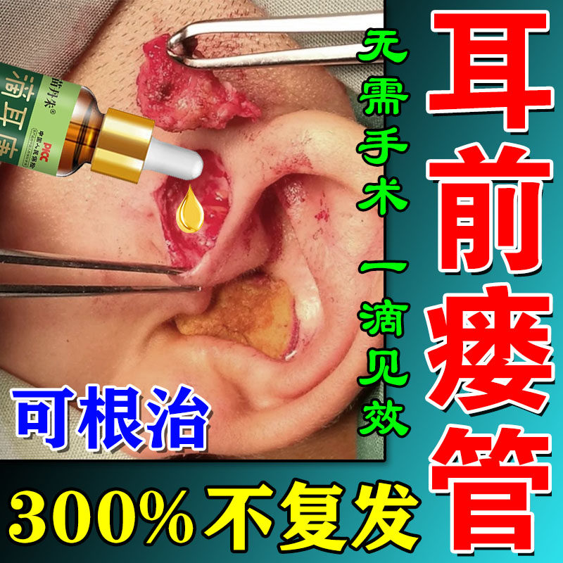 耳前瘘管药膏先天性中耳炎耳仓发炎红肿流脓异味鼓包疼痛瘙痒滴液