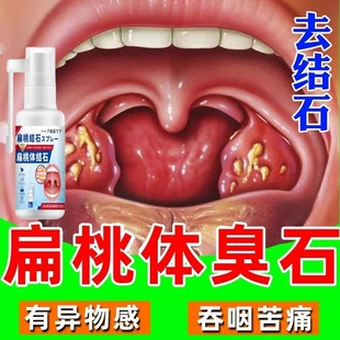 扁桃体结石去除工具喷剂隐窝冲洗器口腔咽喉臭清理漱口水吸引神器