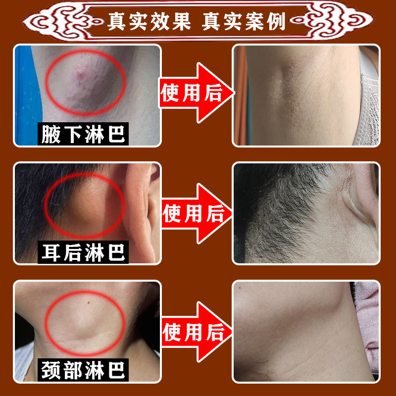 极速淋巴散结消散膏淋巴结消贴专用肿大副乳消除S贴膏结部结节疏