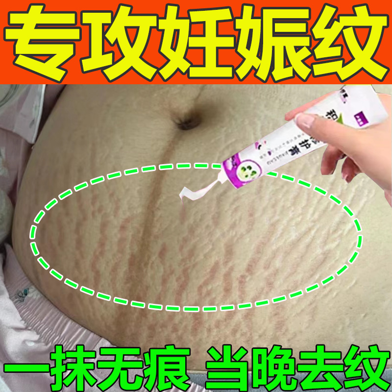去妊娠纹遮挡淡化妊娠纹产后消除紧致妊娠纹淡化肥胖纹修复霜药膏