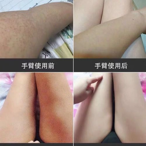 极速维a乳酸膏去鸡皮维a酸乳软膏去鸡皮维aZ酸膏去鸡皮
