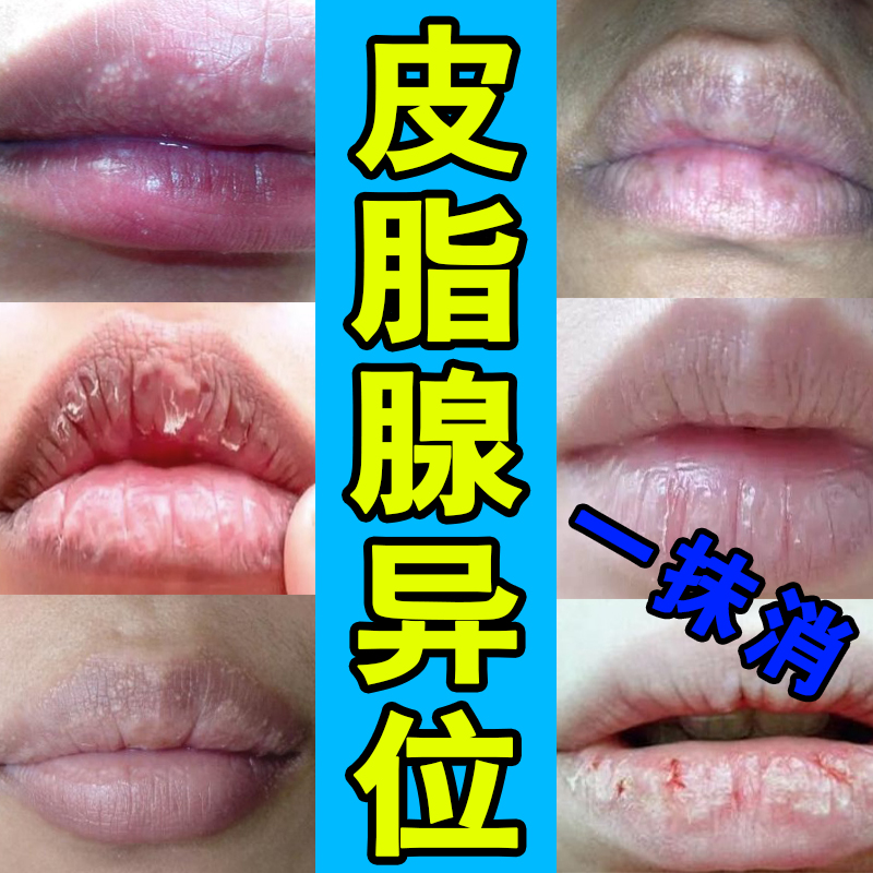 速发皮脂腺异位嘴唇白点增生嘴角红肿起泡脂肪粒乾裂脱皮泡疹拔毒