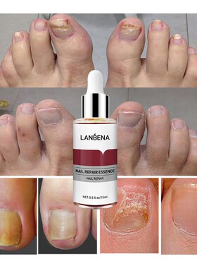 极速Lanbena prego repara??o essncia soro Qfungo remo??