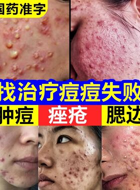 祛痘药膏治痤疮疙瘩粉刺脸反复长痘男女学生成人青春痘淡化祛痘印