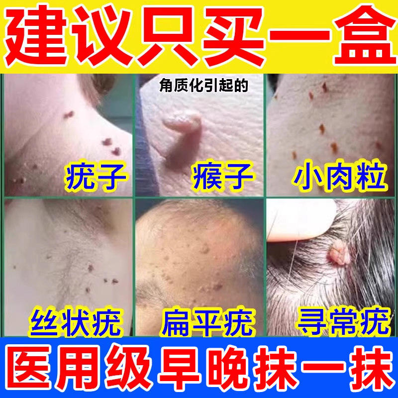 扁平疣祛除软膏去尤瘊脖子上长小肉粒丝状疣一抹灵专用维A酸乳膏