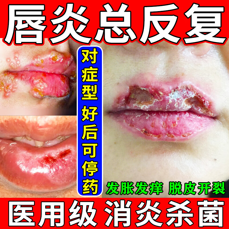 唇炎专用药膏慢性唇炎嘴唇干裂脱皮嘴角疱疹