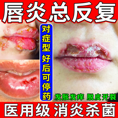 唇炎专用药膏慢性唇炎嘴唇干裂脱皮嘴角疱疹