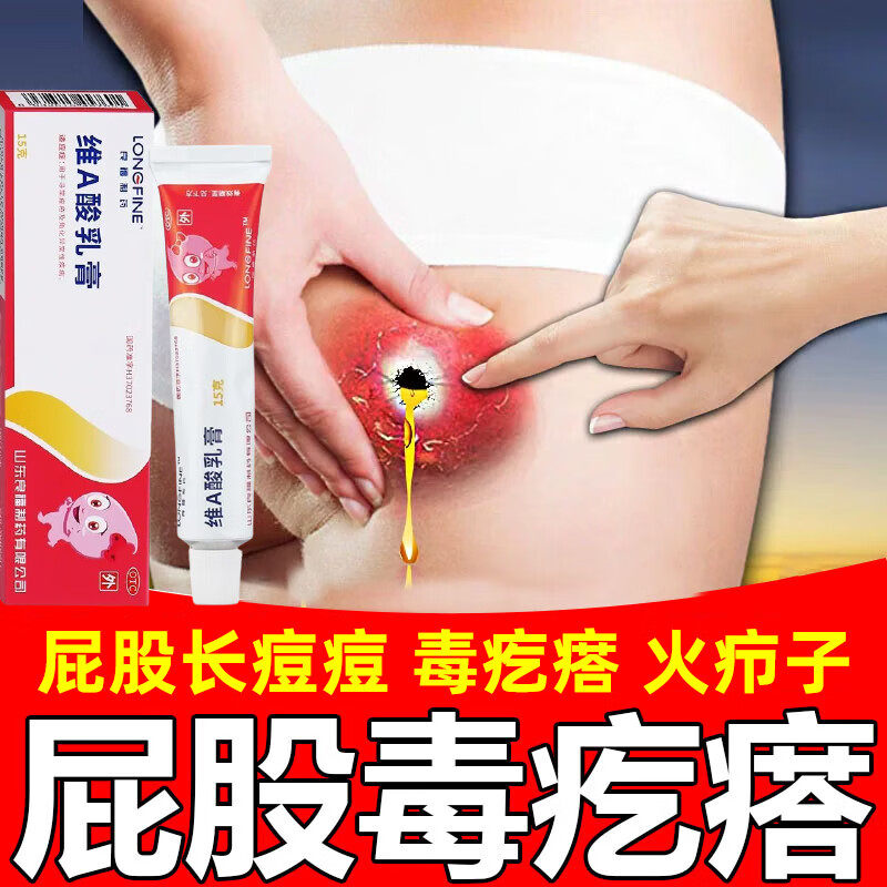 坐板疮药膏火疖子药膏屁股上长痘痘痒起热疙瘩久坐板疮脓包止痒膏