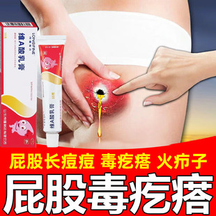 坐板疮药膏火疖子药膏屁股上长痘痘痒起热疙瘩久坐板疮脓包止痒膏
