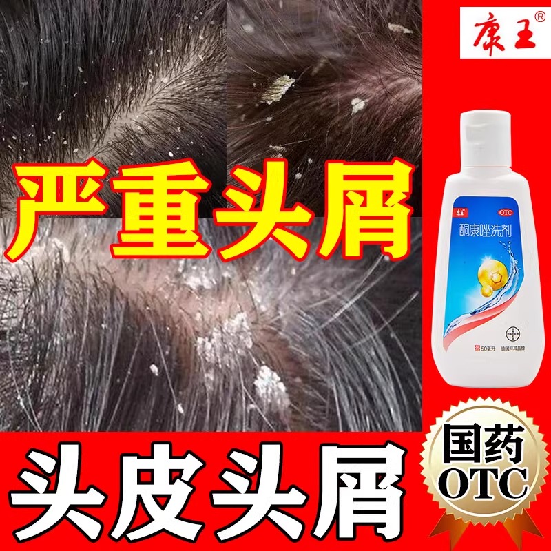 酮康唑洗剂去头屑正品OTC专用药严重头屑脂溢性皮炎头痒专用洗剂