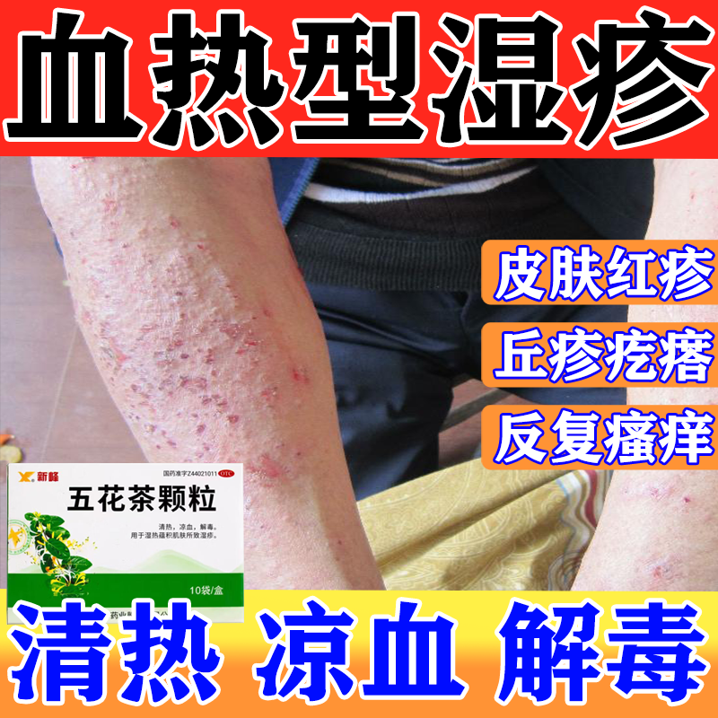 五花茶颗粒凉血清热解毒血热型湿疹止痒去外用顽根固皮炎瘙痒红斑