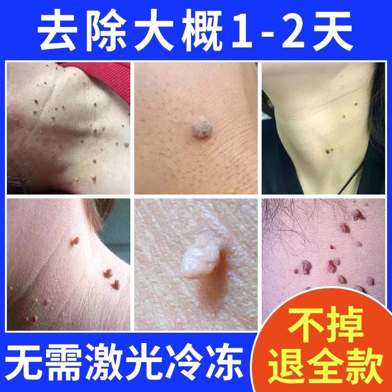 点痣膏点痣药水不留疤美容院专用去痣祛痣膏点痦子无痕正品旗舰店