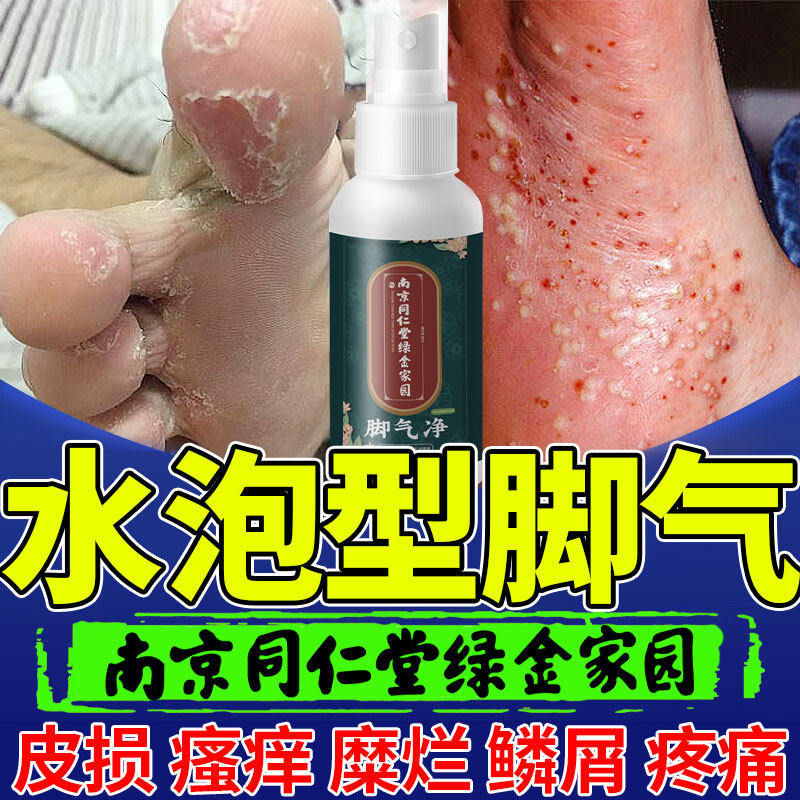 水泡型脚气烂脚丫脚痒臭脚脚趾瘙痒脚底长水泡脚脱皮香港脚kj
