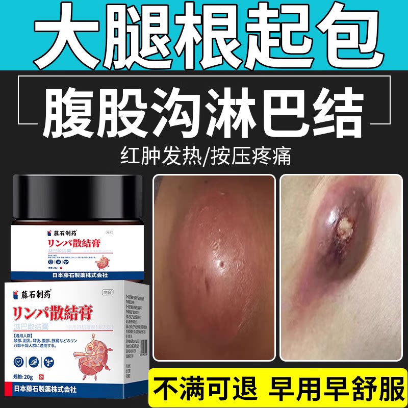大腿根淋巴结腹股沟鼓包红肿发热按压专用疼痛药房同售散结膏lt