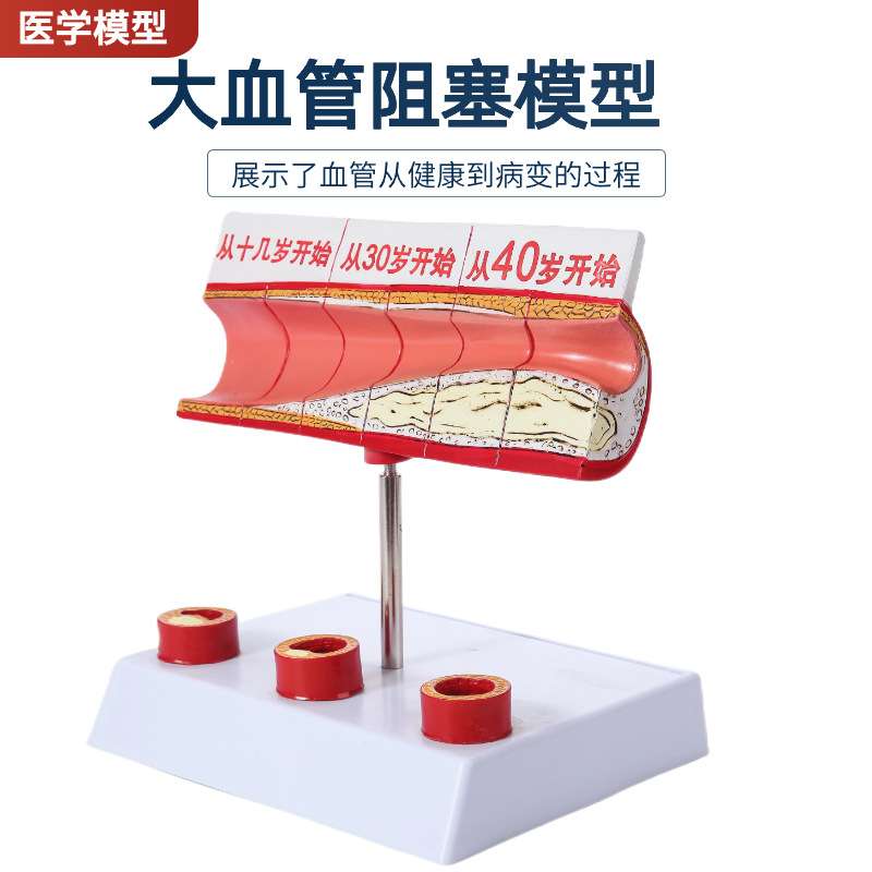 人体血管堵塞动支脉粥样硬化心血管硬化模具演变过程血管病理模型